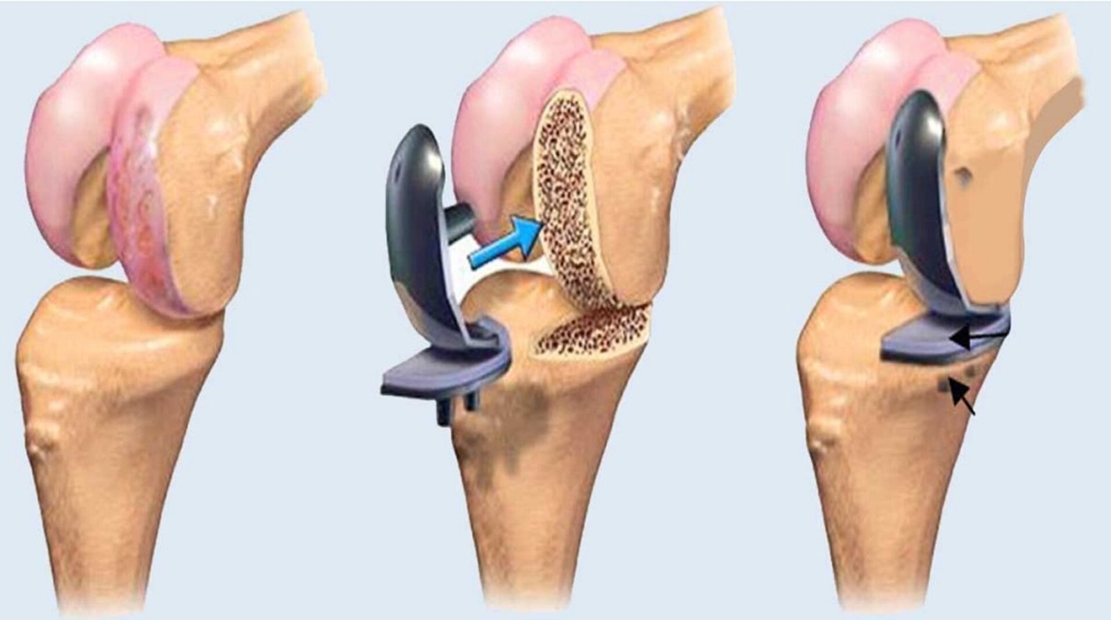 Joint Replacement Surgery